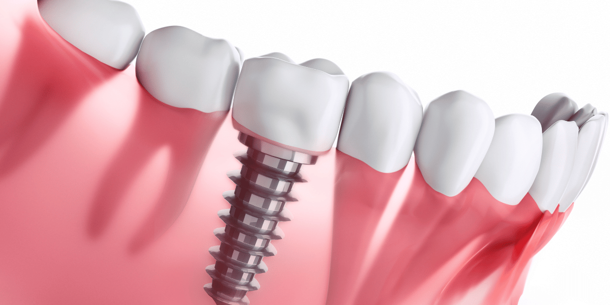 CEID – urgencias en implantes Urgencias Dentales con Implantes Dentales