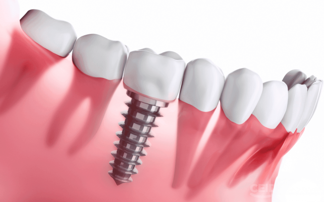 CEID – urgencias en implantes Urgencias Dentales con Implantes Dentales