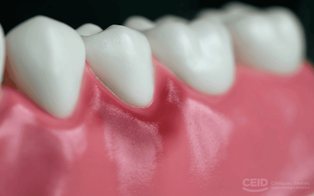 De la gingivitis a la periimplantitis: cuidado de encías alrededor de implantes