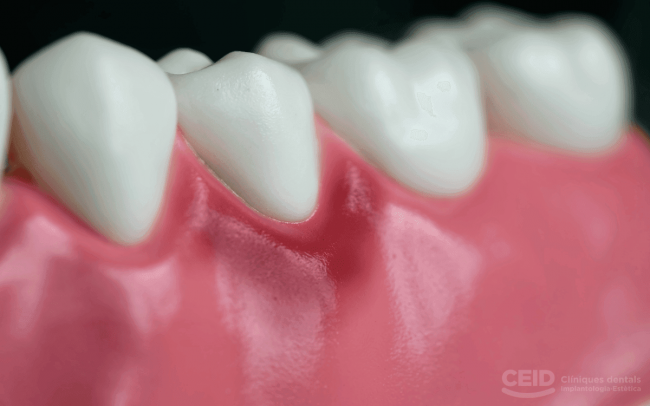 CEID – gingivitis gingivitis