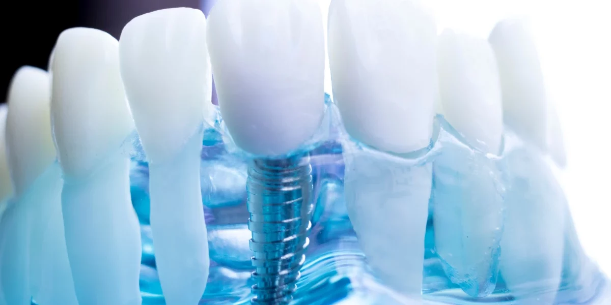 Tratamiento de periimplantitis en Barcelona – CEID Clínicas Dentales