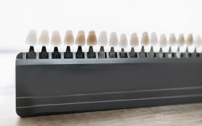 Carillas Dentales Precio – CEID