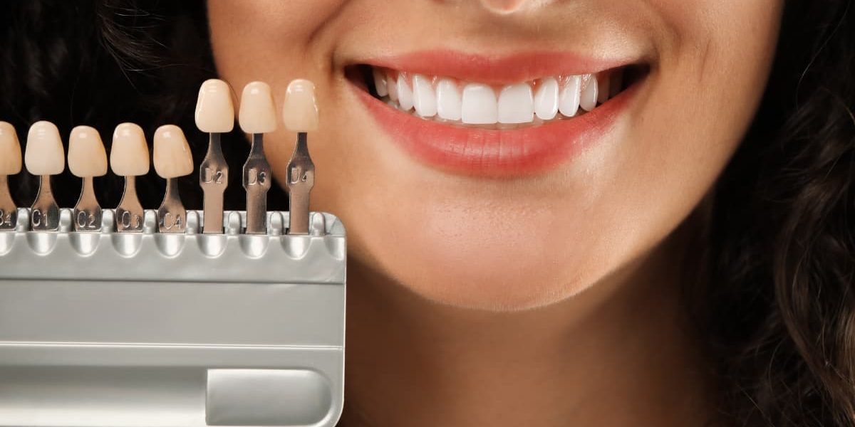 Carillas dentales en Barcelona – precios y opciones en CEID