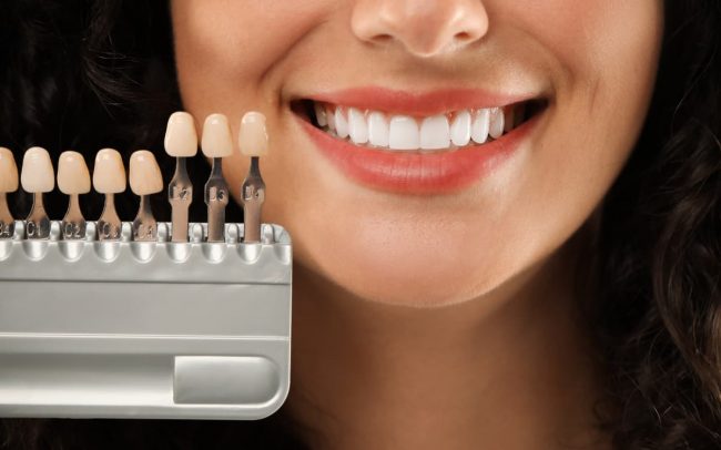 Carillas dentales en Barcelona – precios y opciones en CEID