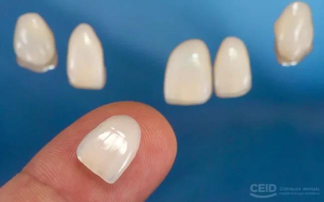 Carillas sin tallado en Barcelona – CEID