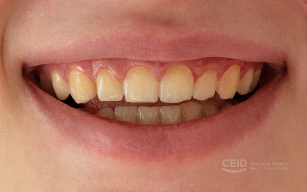 Tratamiento para manchas de tetraciclinas con Carillas Dentales