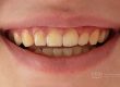 Dientes manchados Tetraciclina