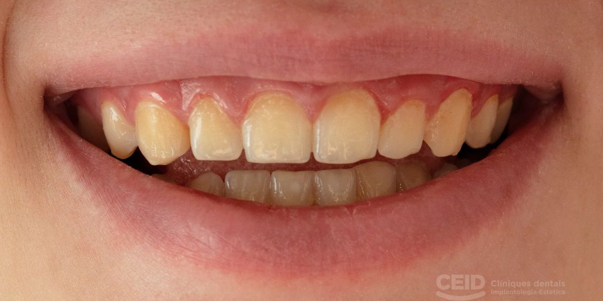 Dientes manchados Tetraciclina Dientes manchados Tetraciclina