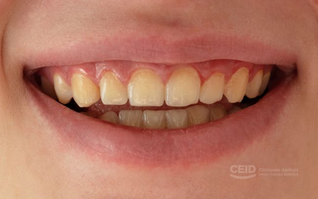 Dientes manchados Tetraciclina Dientes manchados Tetraciclina