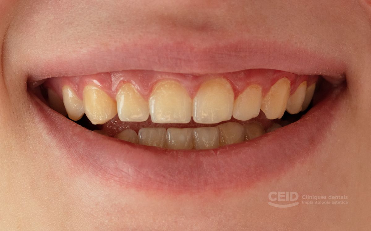 Dientes manchados Tetraciclina