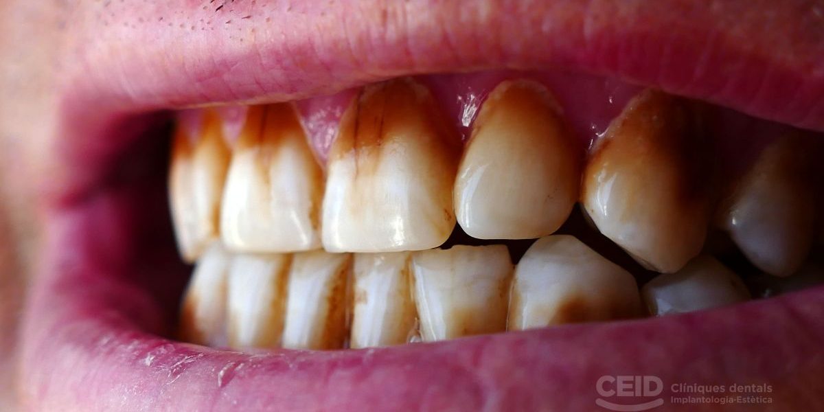 Dientes manchados - Tinción extrema
