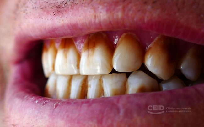 dientes-con-manchas-tincion-extrema Dientes manchados - Tinción extrema