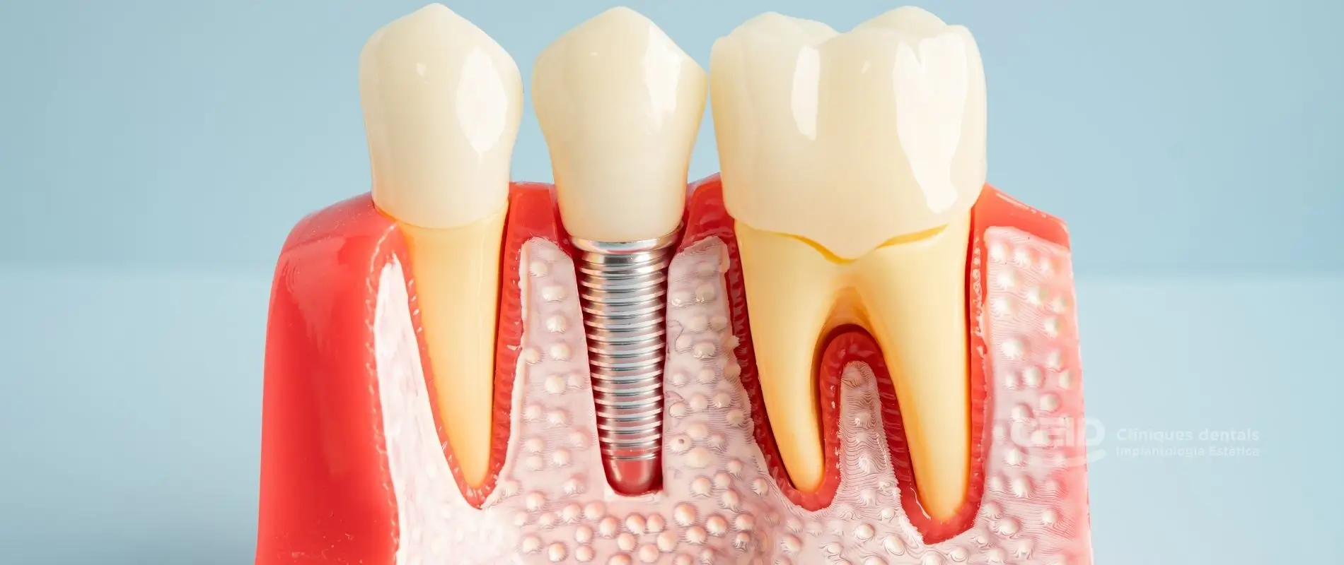 Maqueta de implantes de carga inmediata en Barcelona