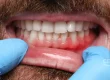 Encías antes de tratamiento de periodoncia con láser