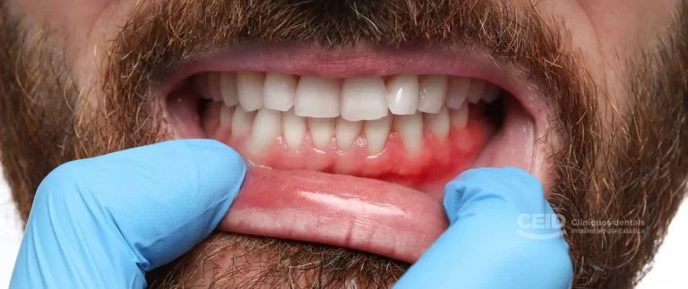 Láser aplicado en el tratamiento periodontal: menos invasivo, menos dolor