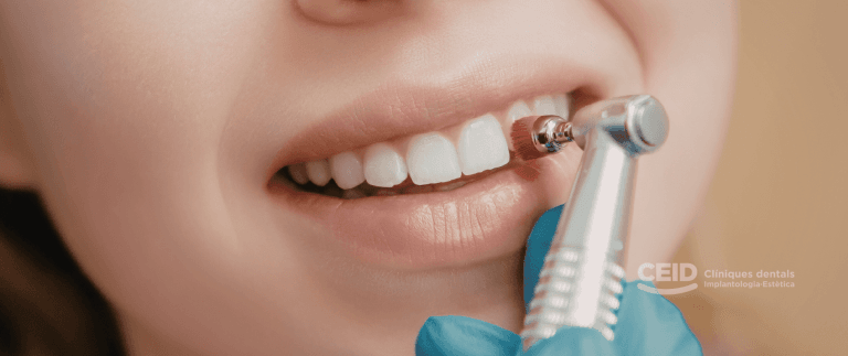 Stripping dental en ortodoncia: qué es, cuándo se recomienda y sus beneficios