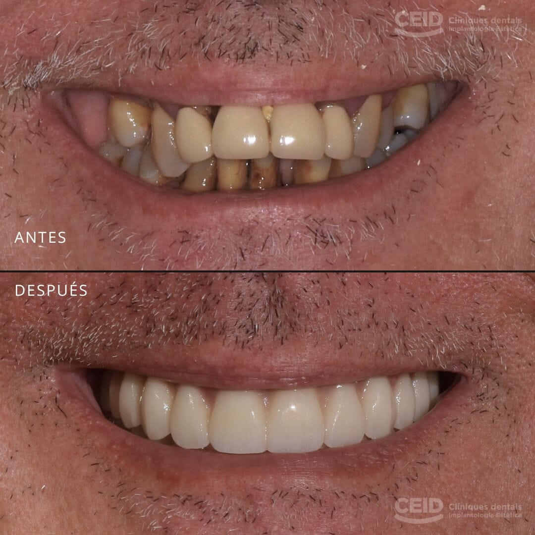 Paciente CEID antes y después de realizarse tratamiento de implantes