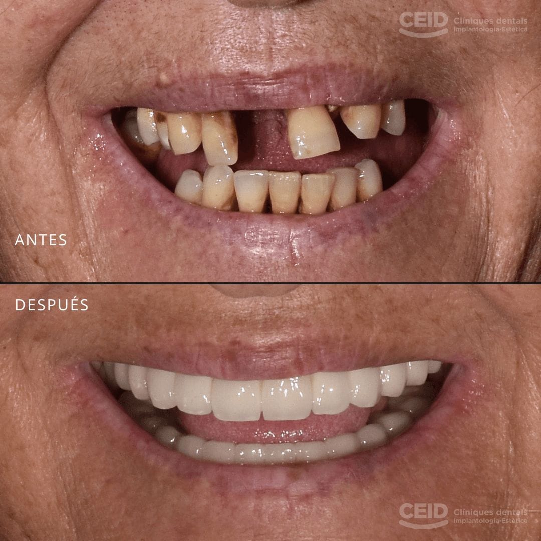 Caso de éxito de tratamiento de implantes dentales en CEID