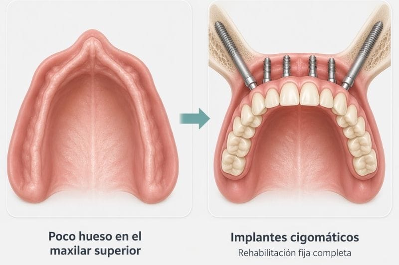 Falta mucho hueso maxilar, solución: implantes cigomáticos