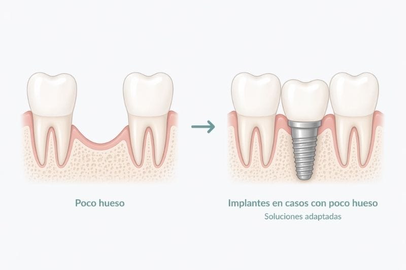 Implantes con poco hueso